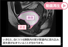 【膀胱瘤のシネMRI動画】