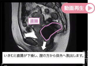 【直腸瘤のシネMRI動画】
