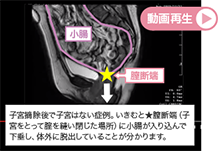 【小腸瘤・膣断端脱のシネMRI動画 （子宮摘除後の方）】