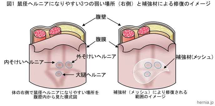 腹腔鏡下ヘルニア修復術(腹腔内到達法TAPP法、腹膜外到達法TEP法)