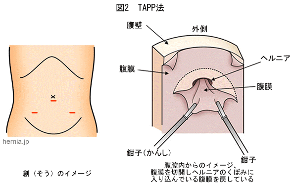 腹腔内到達法TAPP法