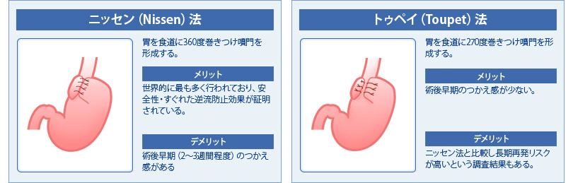 逆食手術術式