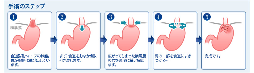 逆食手術の流れ