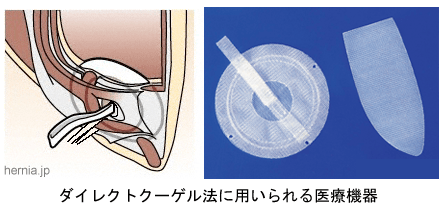 ダイレクトクーゲル法