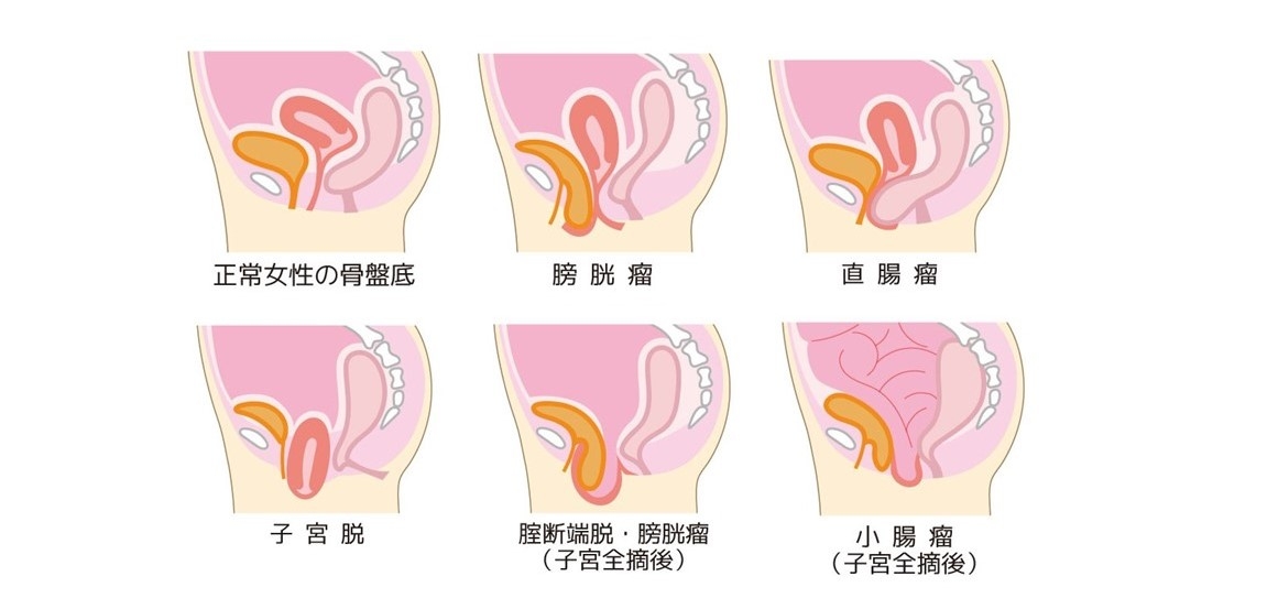 症状 子宮 脱