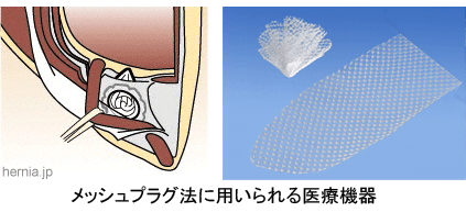 メッシュプラグ法