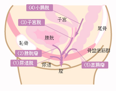 a 骨盤臓器脱とは